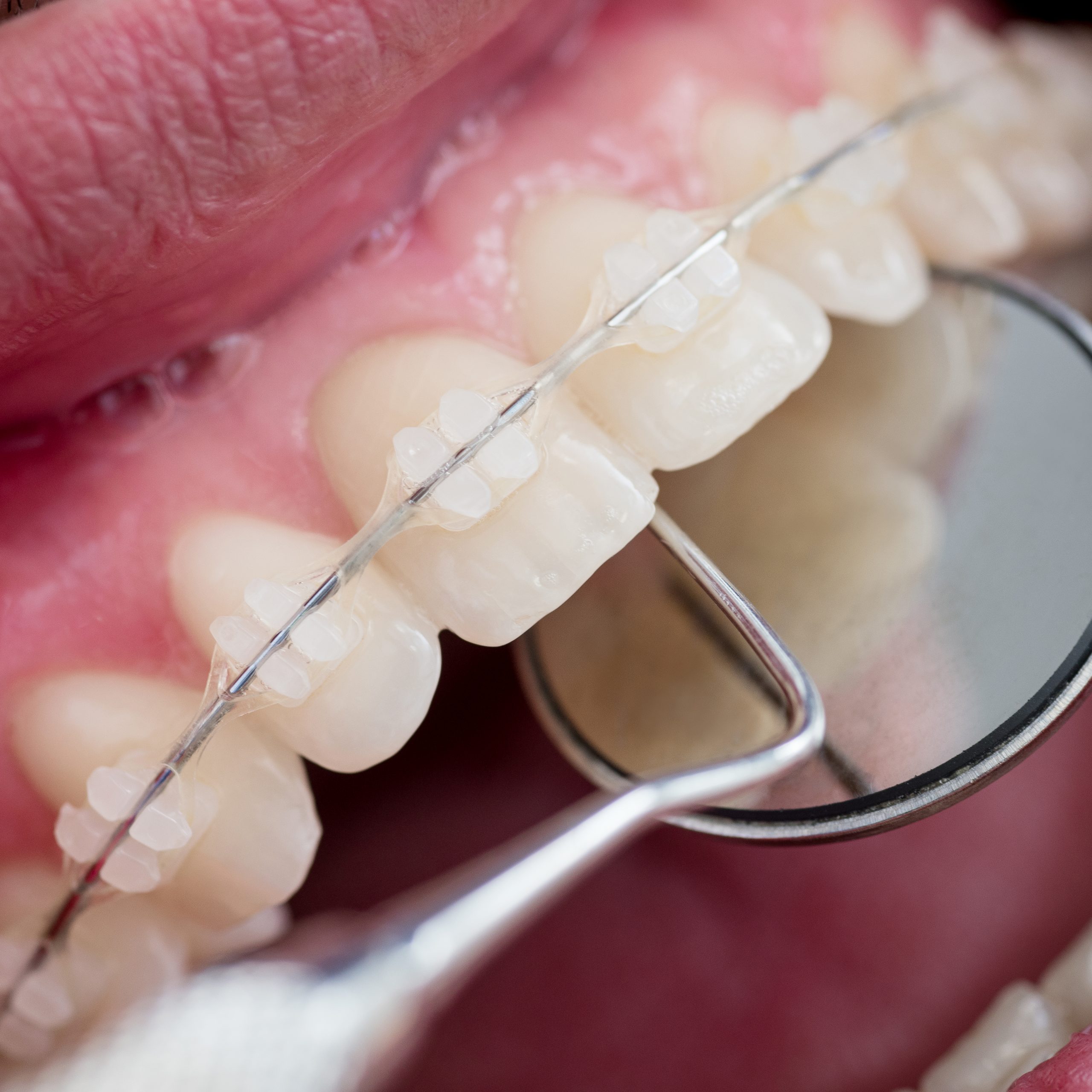 Dentist checking up teeth with ceramic brackets using dental tools - probe and mirror at the dental office. Macro shot of teeth with braces. Orthodontic Treatment. Dentistry